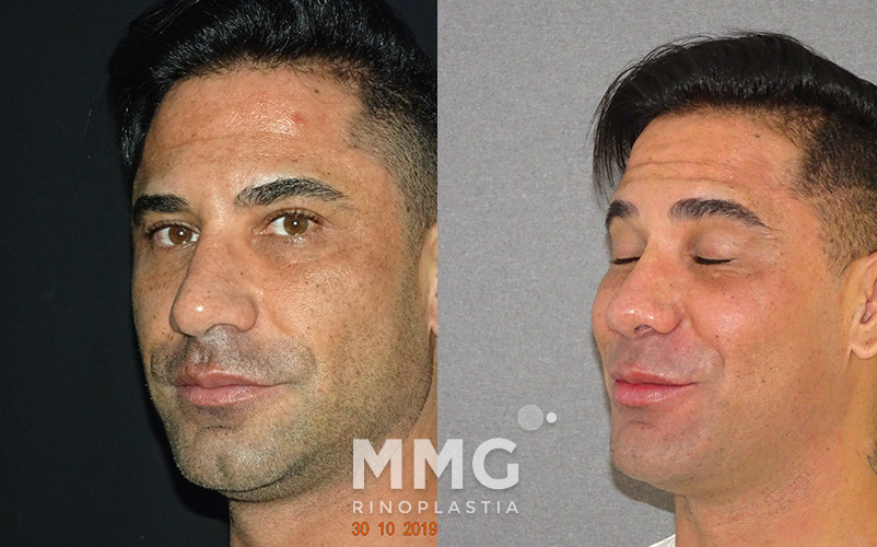 Antes y después de operación de rinoplastia