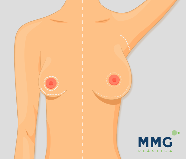 Cirugía mamaria,Aumento de pecho